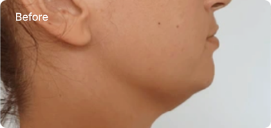 rejouir_implant